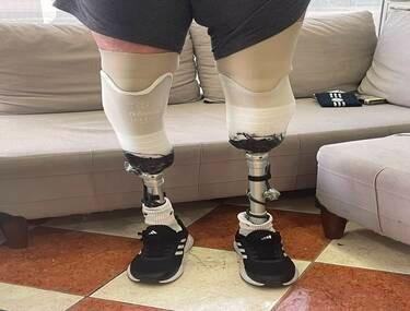 Diz Altı Protezi